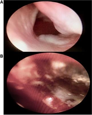 Pediatric invasive fungal rhinosinusitis